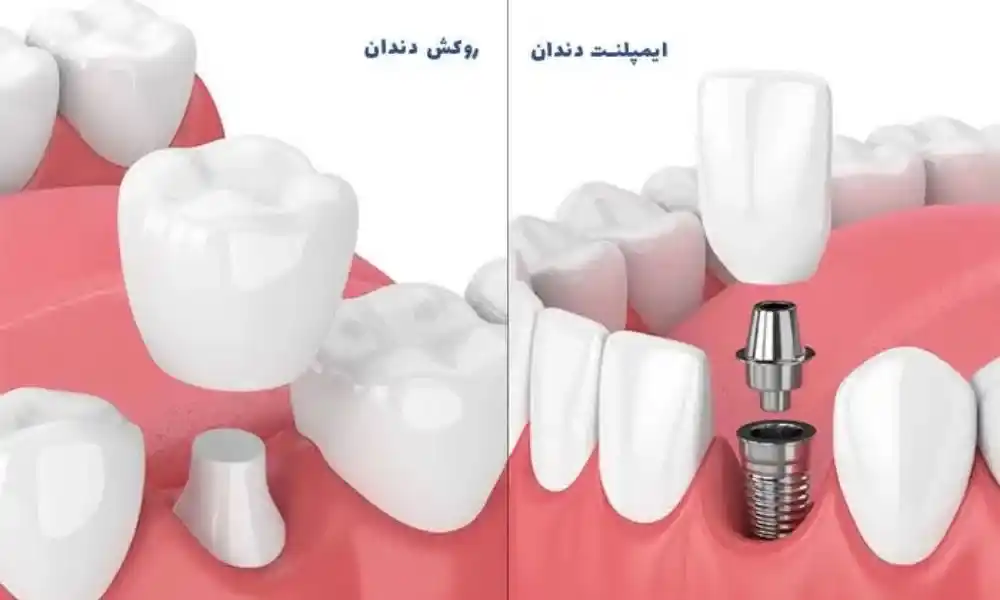 تفاوت روکش و ایمپلنت دندان