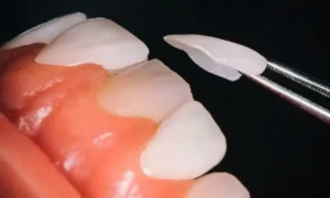 لمینت دندان برای چه کسانی مناسب است؟ راهنمای جامع انتخاب لمینت