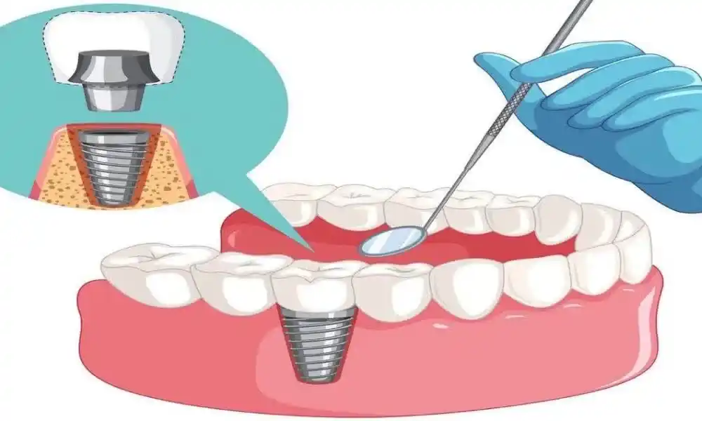 چه کسانی نمی‌توانند ایمپلنت دندان انجام دهند؟