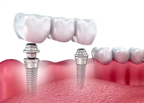 Implant-based bridge