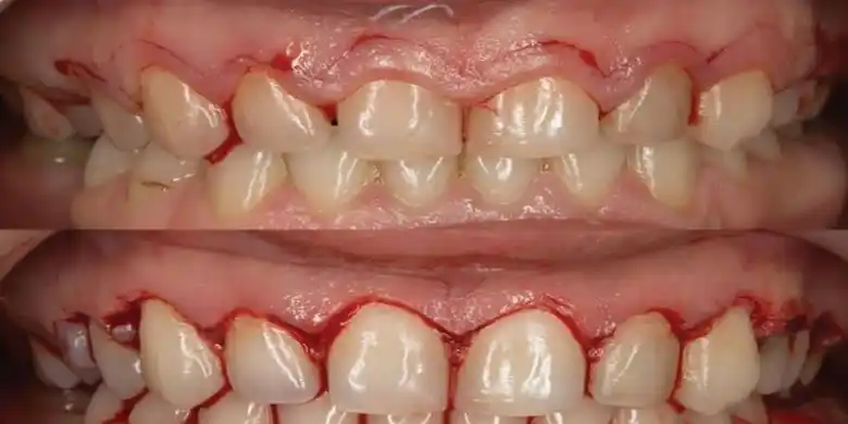 What is gum surgery?, Gum surgery