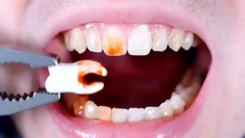 Complications of tooth extraction
