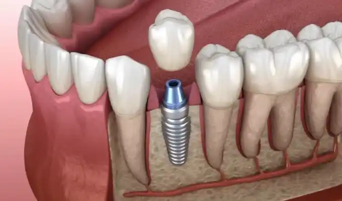 Dental implants