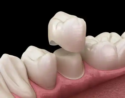 Denture with dental crown