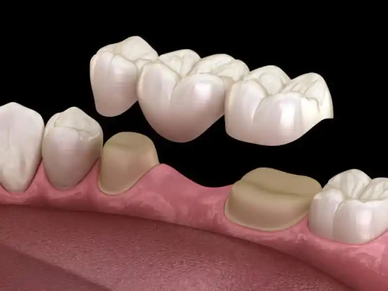 Dentures with dental bridges