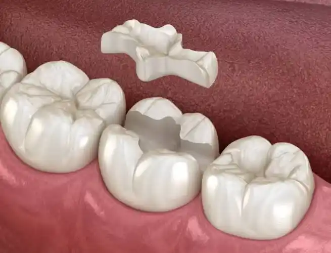 Dentures with inlays and ceramic inlays