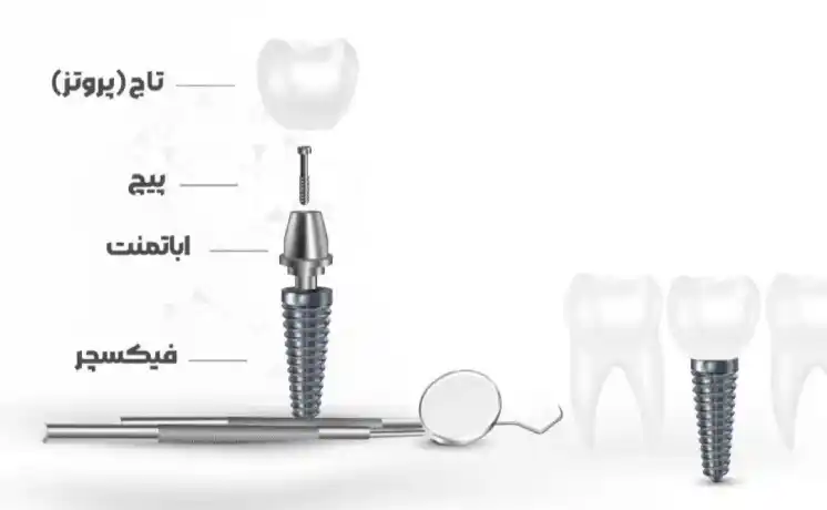 Implant components