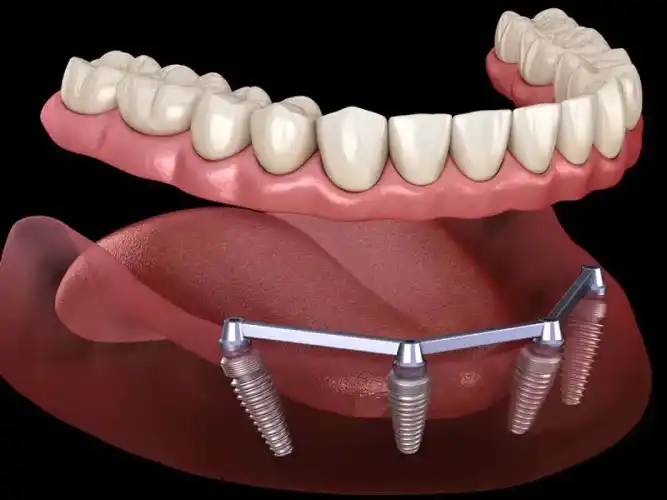 Implant-supported overdenture or complete denture