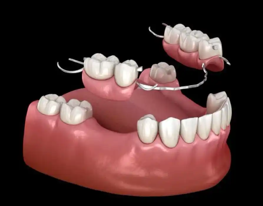 Partial denture