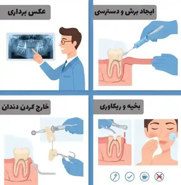 Tooth extraction steps