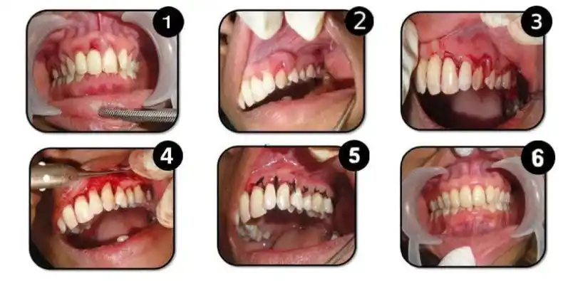 Types of gum surgery methods