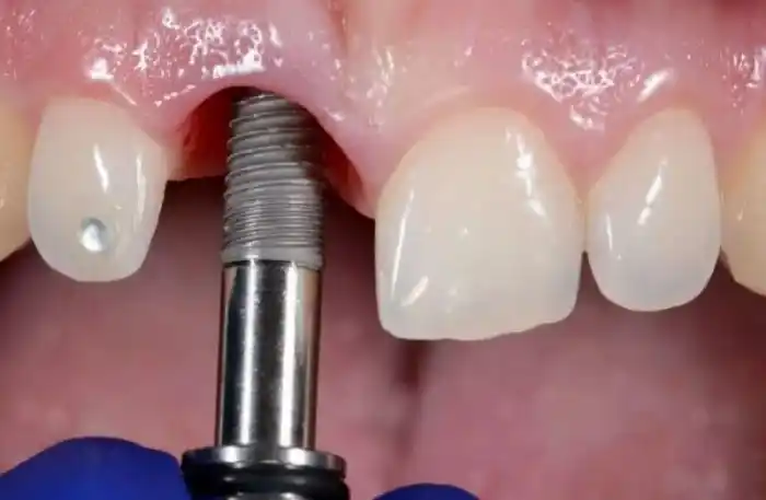 What are the disadvantages of dental implants?