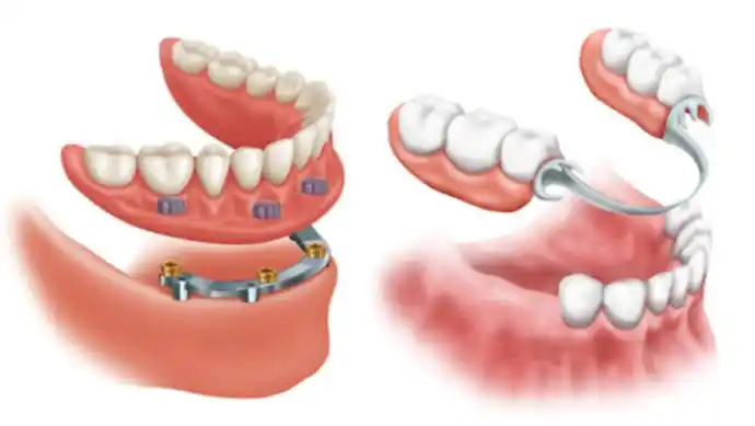 What is a dental prosthesis?
