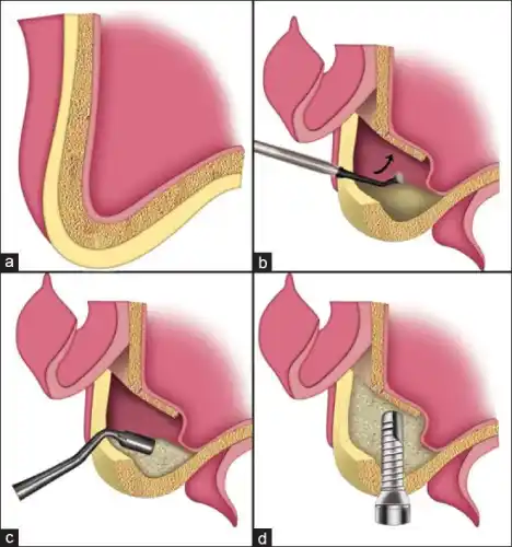 What is a sinus lift?