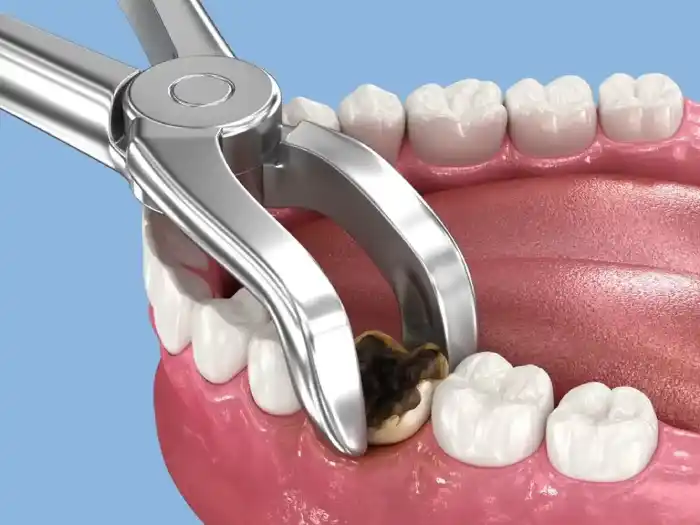 What is tooth extraction?