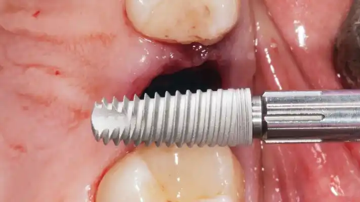 Who is a dental implant suitable for?