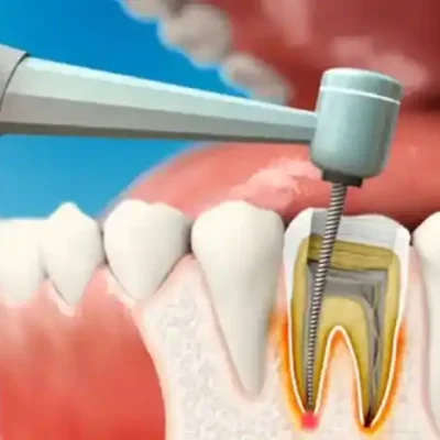 When do we need root canal treatment