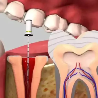 When is retreatment of root canaled tooth needed