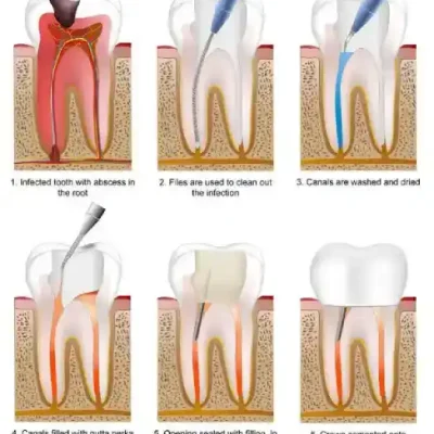 what is dental root canal treatment